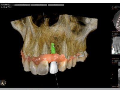 Implants