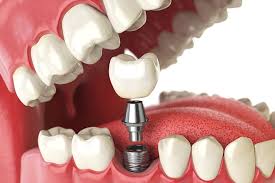 implant-unitari-implante-dental