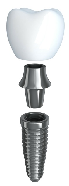 implant-corona-pilar