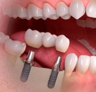 implante avanzado implant dental implantologia