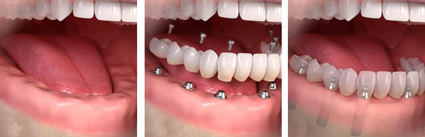 protesis fixa sobre implants Talavera Valles Implantologia