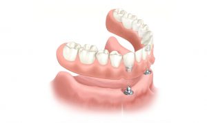 sobredentadura implants calafell Talavera Valles implantologia
