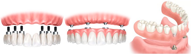 tipus de protesis sobre implants